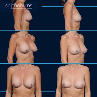 before and after explant surgery by Dr. Burns