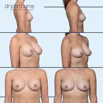 explant before and after by Dr. John Burns in Dallas, Texas