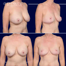 explant c lift and fat transfer by Dr. John Burns MD in Dallas, Texas.png__PID:3f6a43e5-766e-4403-8c5b-89716c344d33