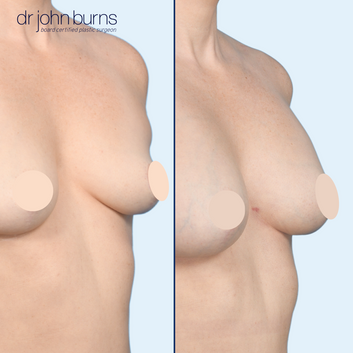 fat transfer before and after in Dallas- TX, Dr. John Burns.png__PID:1a1a200d-57ec-473e-8711-673765cbe3a1