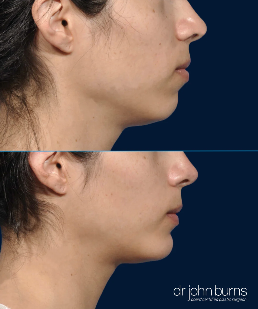 female chin implant before and after by Dr. John Burns in Dallas, TX.png__PID:53d03817-fa89-4ce7-b668-fe385fc08cfc