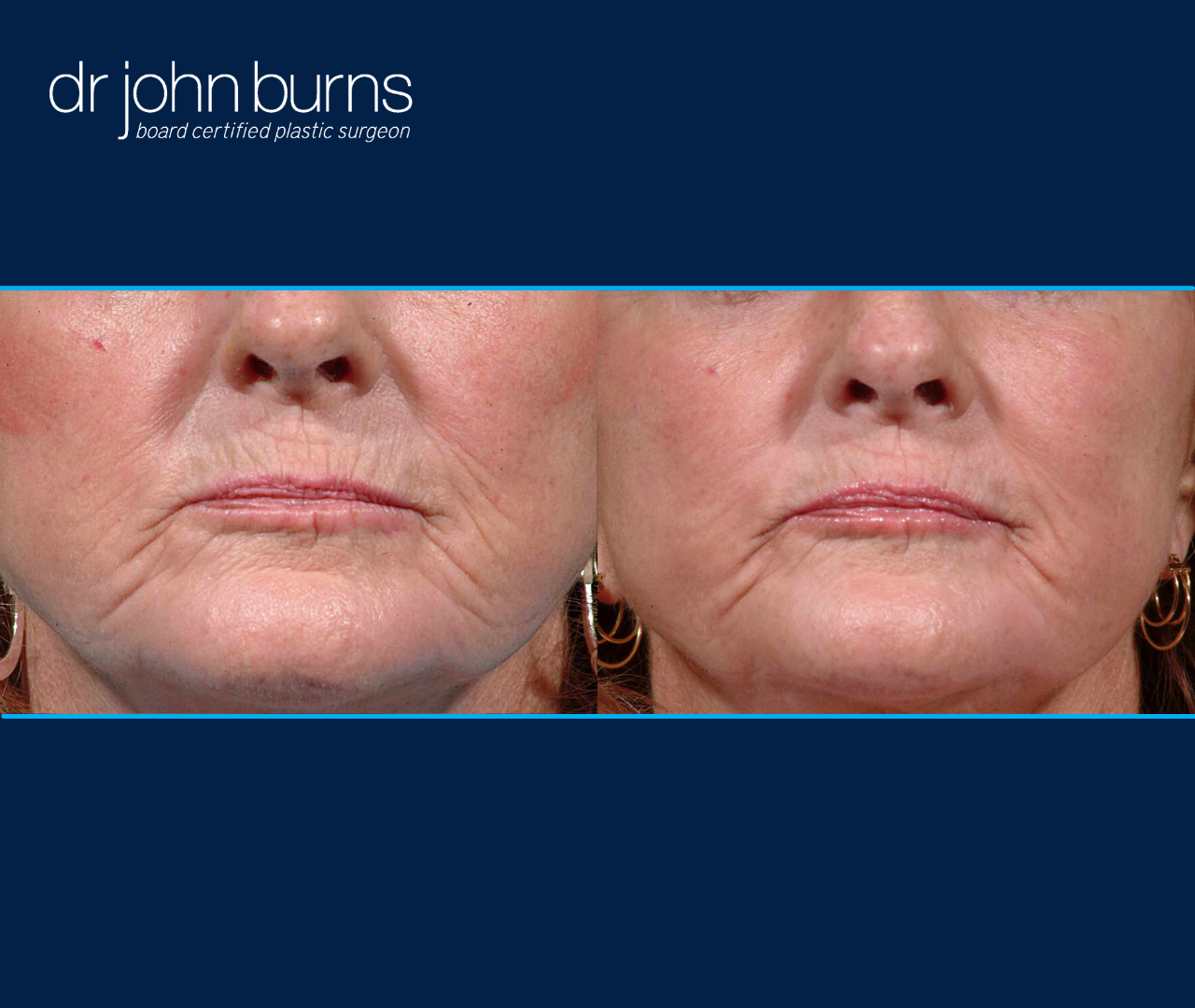 laser resurfacing before and after lip lines by Dr. John Burns.png__PID:9c7543e1-68f9-4327-a1bc-3e107967715f