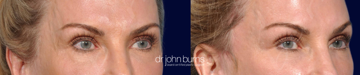 Before & After Endoscopic Brow Lift by Dr. John Burns