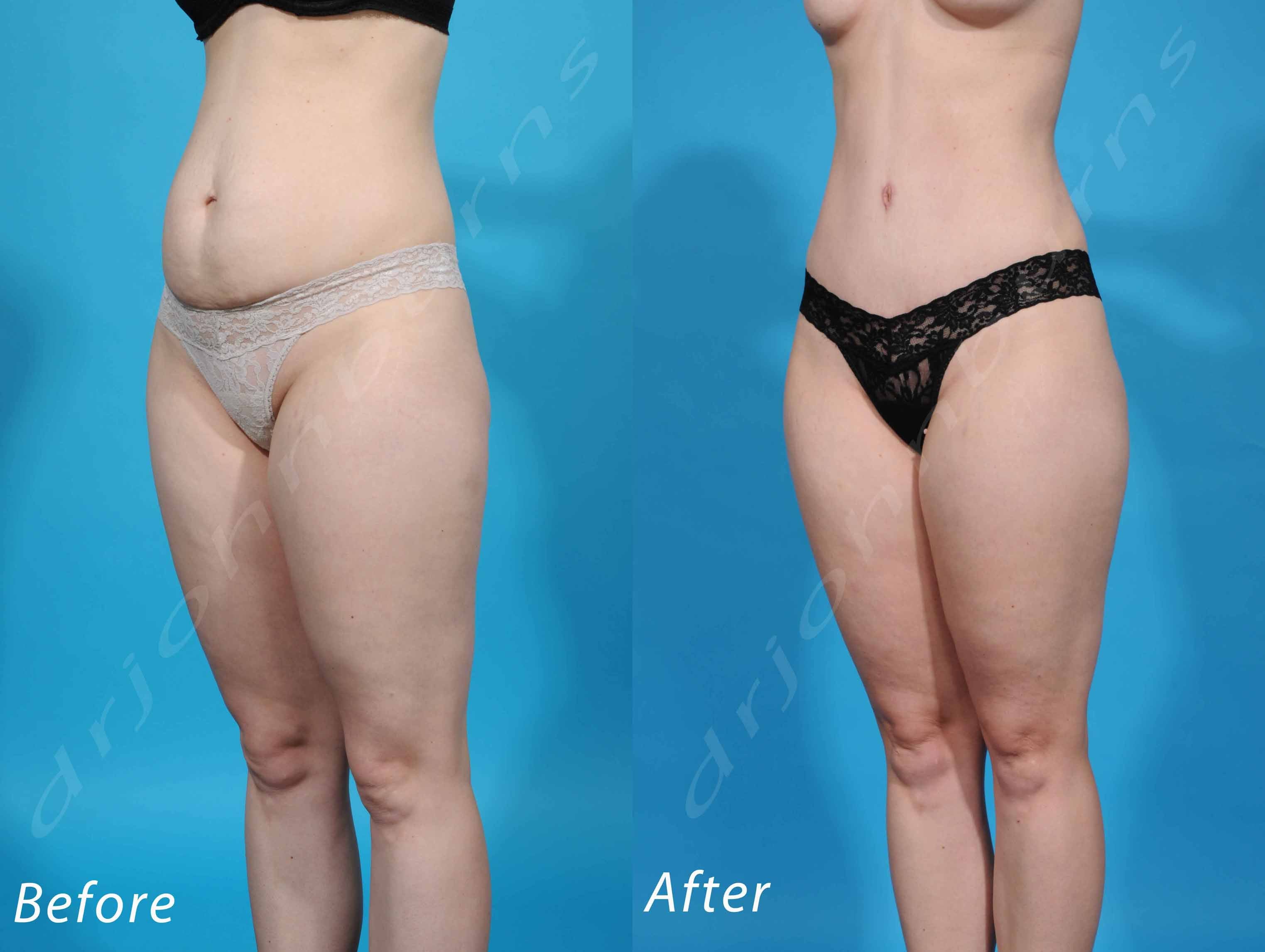 Ford Plastic Surgery - The gold standard for abdominal body contouring is  abdominoplasty or tummy tuck surgery with associated liposuction.  Abdominoplasty surgery tightens underlying rectus abdominis muscles to  improve waistline contour and