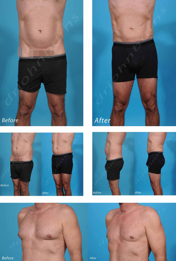 Liposuction Cost Austin