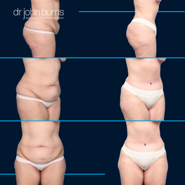 Optimizing Your Tummy Tuck Scars: Getting The Best Results Possible – Dr  John Burns