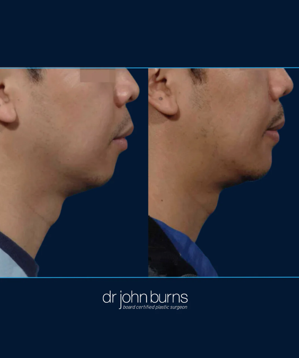 male chin implant Dr. John Burns, Dallas, TX.png__PID:3817fa89-fce7-4668-be38-5fc08cfcb4d0