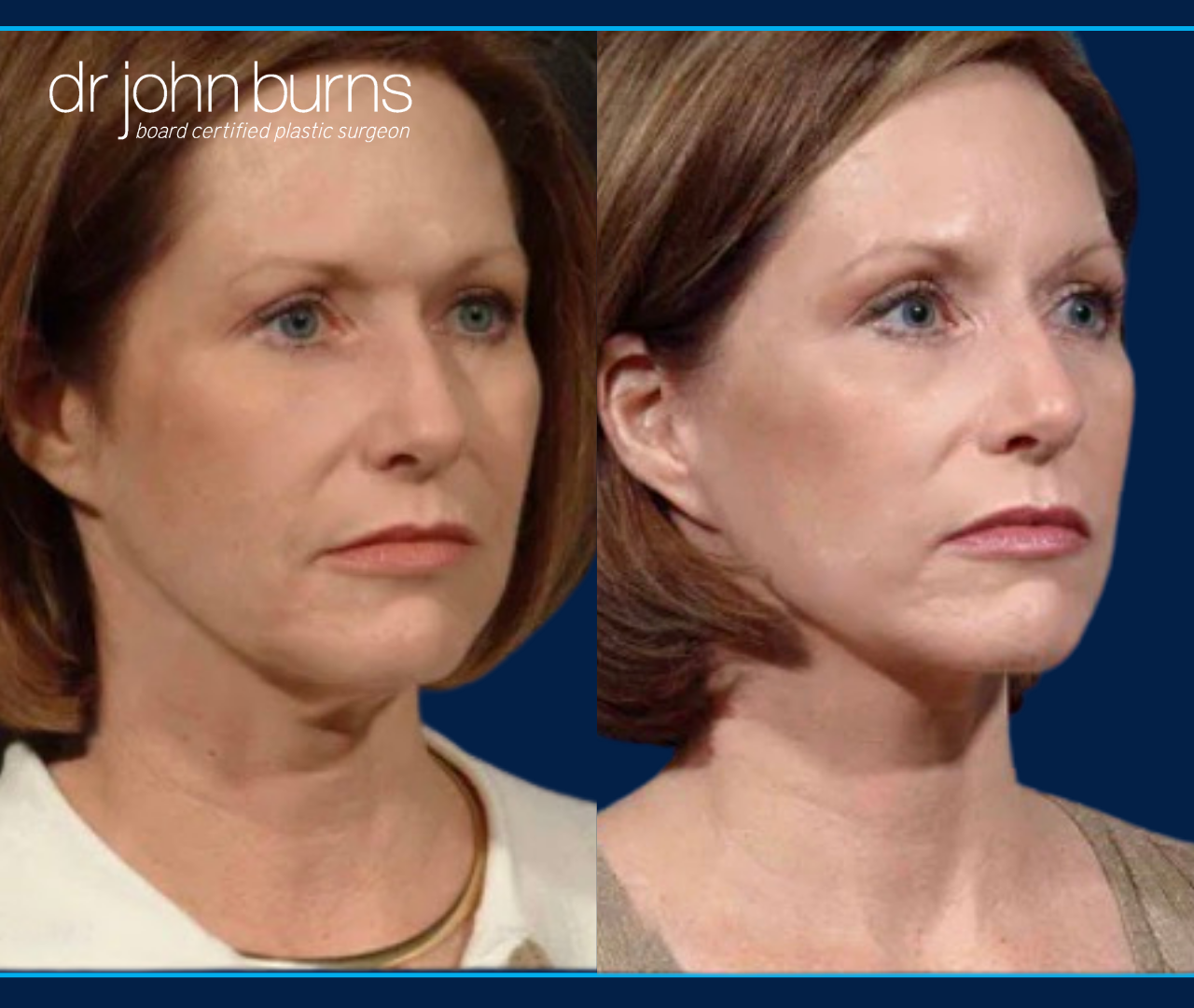 Right 45 Degree View | Before and After Dallas Mini Facelift and Rhinoplasty by Dr. John Burns