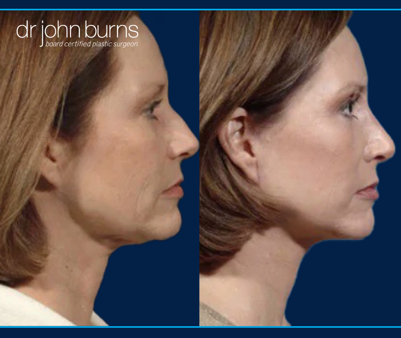 Profile View | Before and After Dallas Mini Facelift and Rhinoplasty by Dr. John Burns