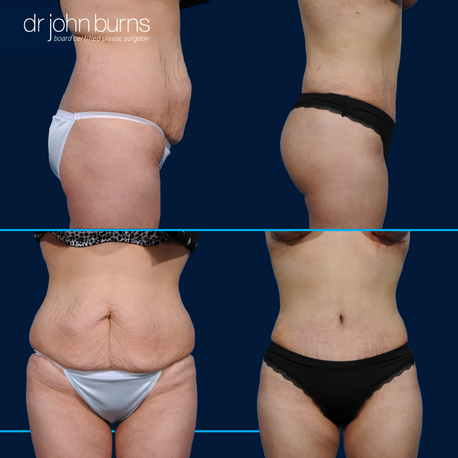 Before and after mommy makeover, tummy tuck and bbl by Dr. John Burns