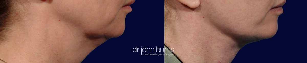 before & after neck lift surgery by Dr. John Burns