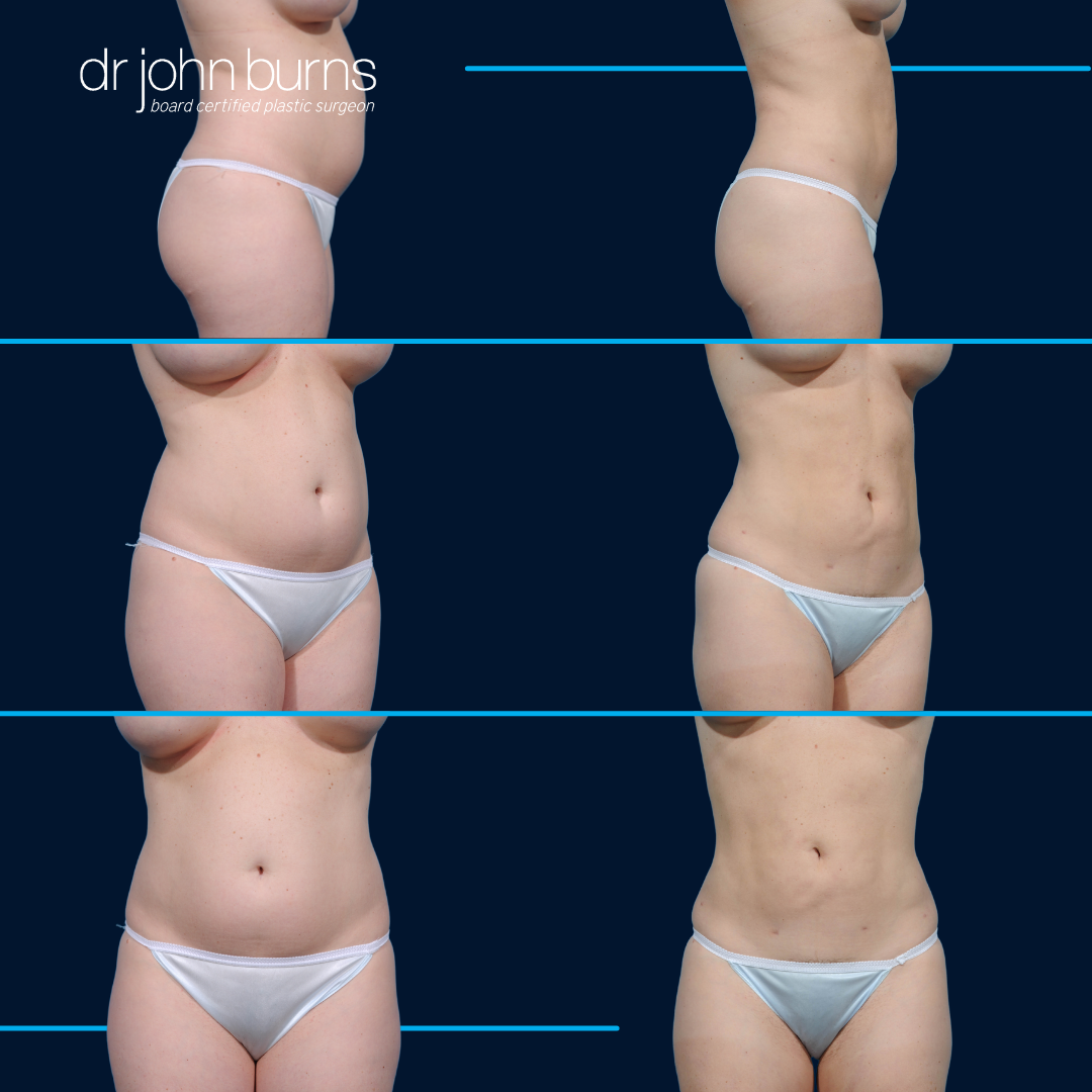female lipo before and after  abs and flanks by Dr. John Burns in Dallas, Texas