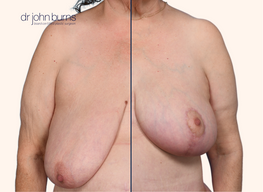 before and after full breast lift after massive weight loss by Dr. John Burns