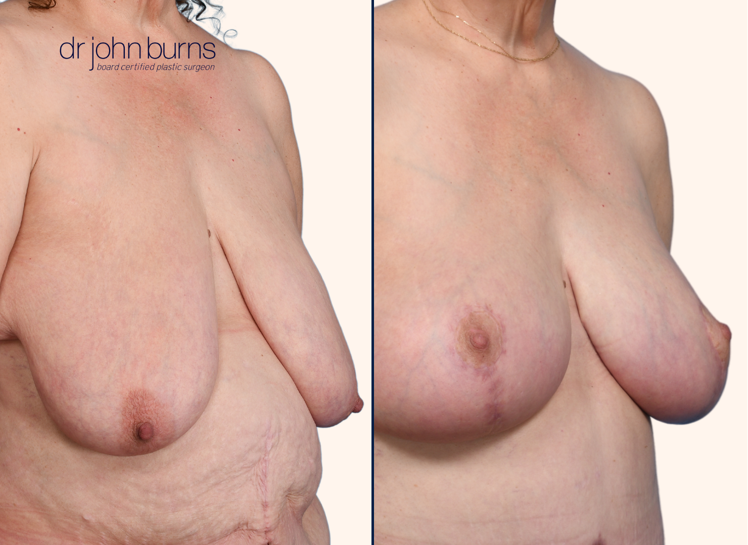 before and after full breast lift after massive weight loss by Dr. John Burns