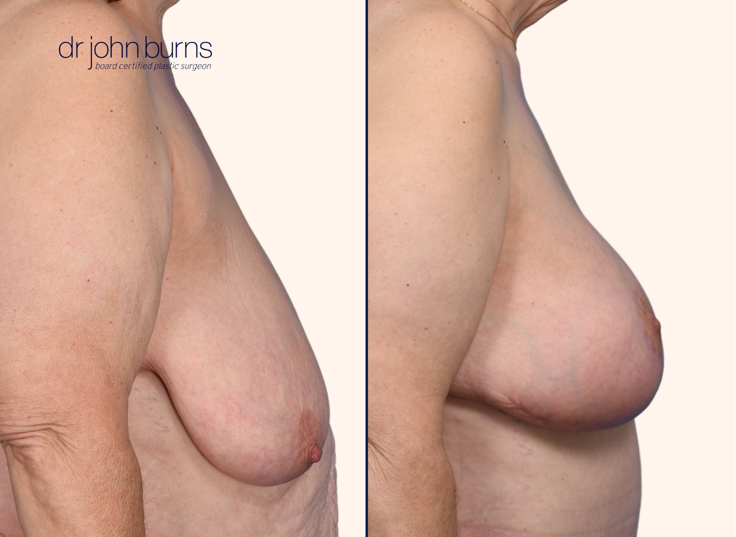 before and after full breast lift after massive weight loss by Dr. John Burns