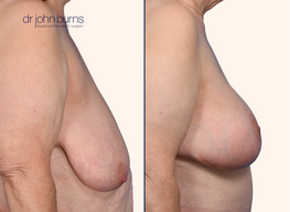 before and after full breast lift after massive weight loss by Dr. John Burns