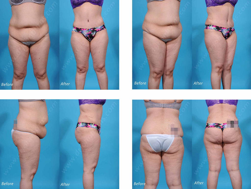 Extended Tummy Tuck- Dallas Plastic Surgeon- Dr. John Burns – Dr John Burns