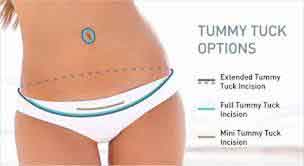 Tummy Tuck Revision: Ultimate Guide by CREO