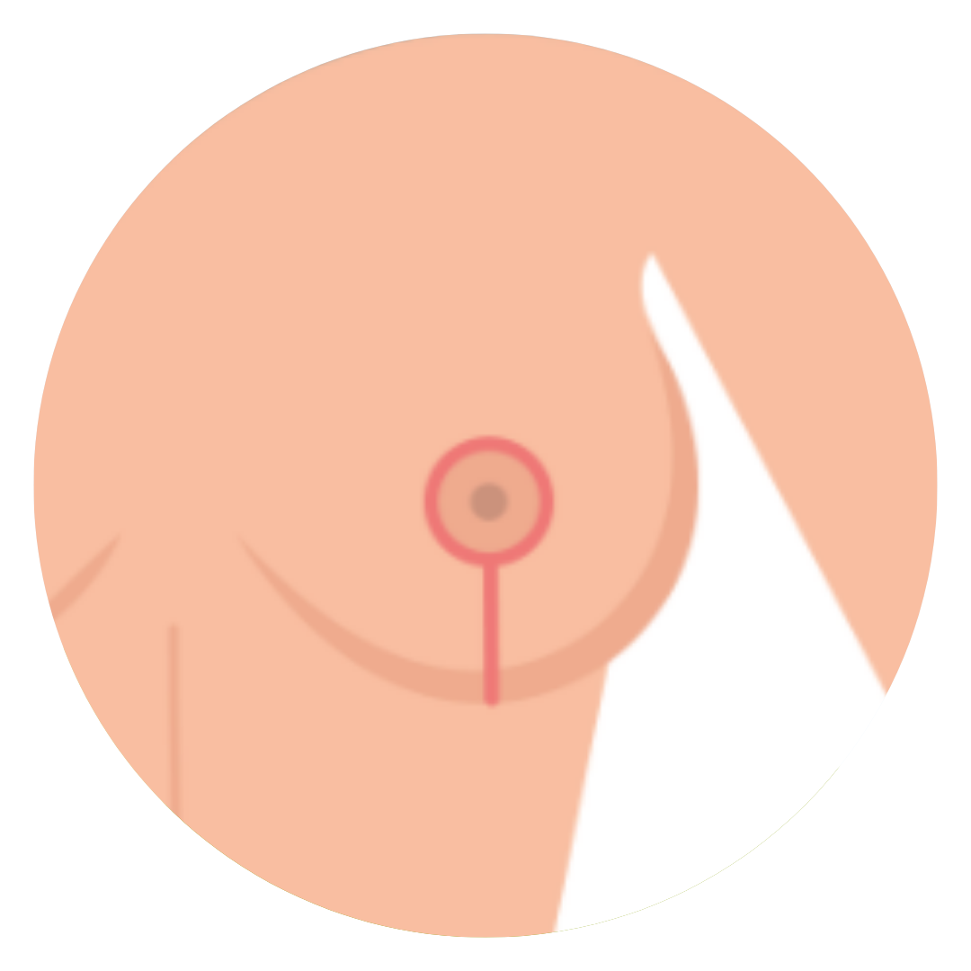 vertical (lollipop) breast lift by Dr. John Burns.png__PID:2c6eb856-5d0e-40ae-937f-83f6166322aa