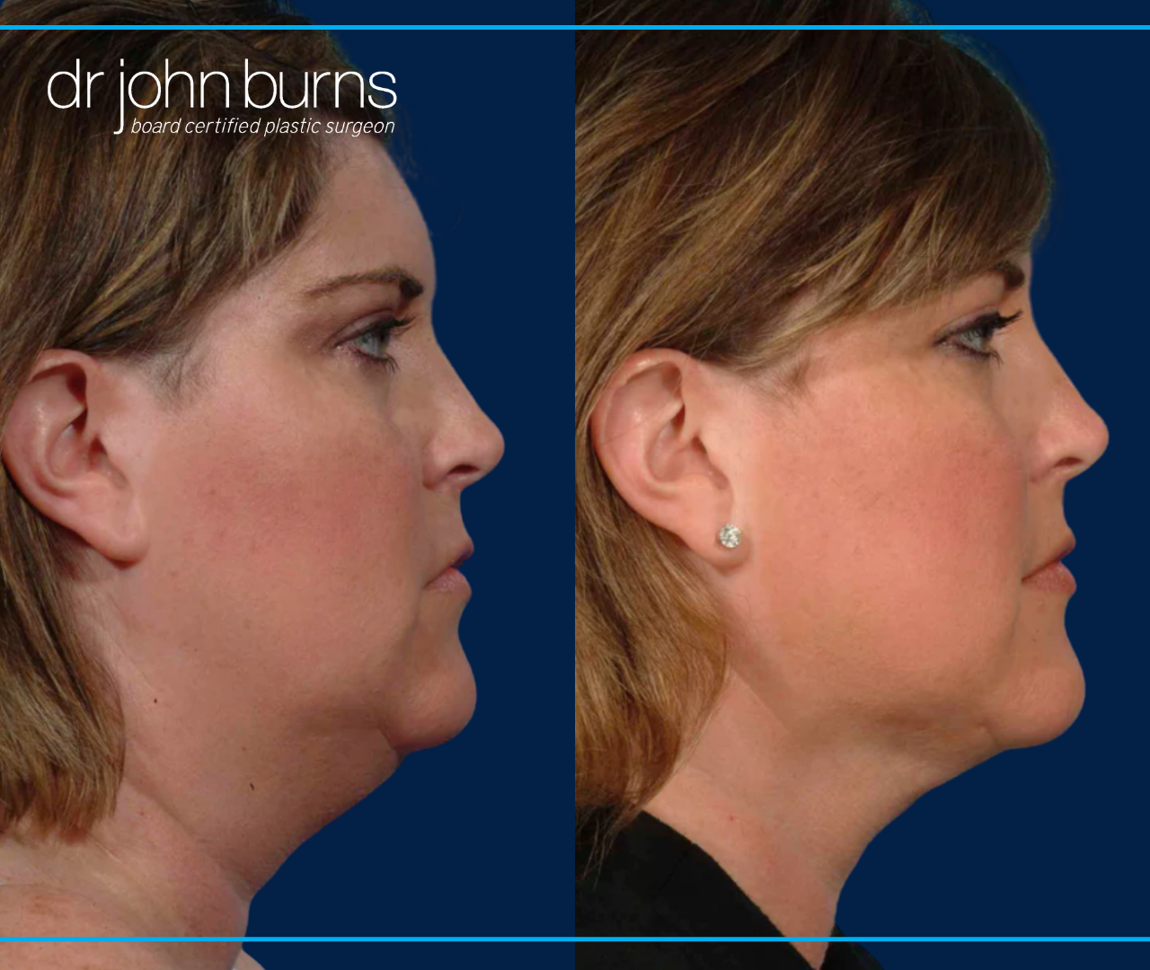 Right profile view | before and after neck lift with liposuction by Dallas Plastic Surgeon, Dr. John Burns