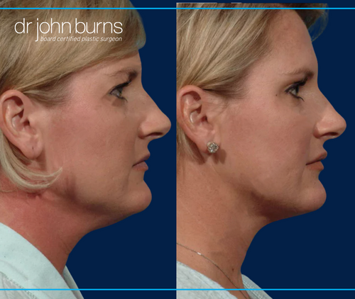 right profile view | before and after Dallas neck lift with liposuction