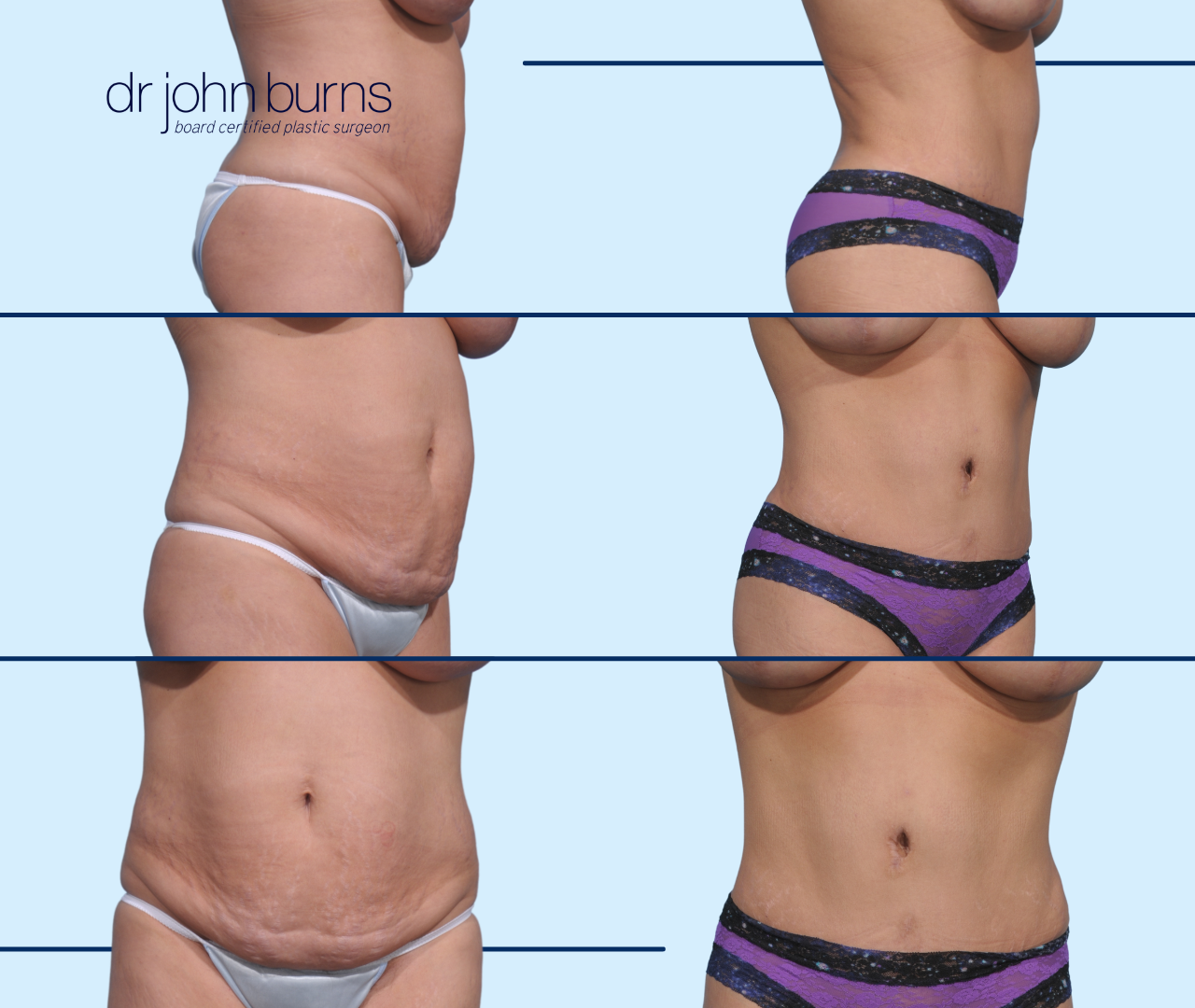 Case 10- Before & After Tummy Tuck, BBL, Lipo 360 by Dr. John Burns