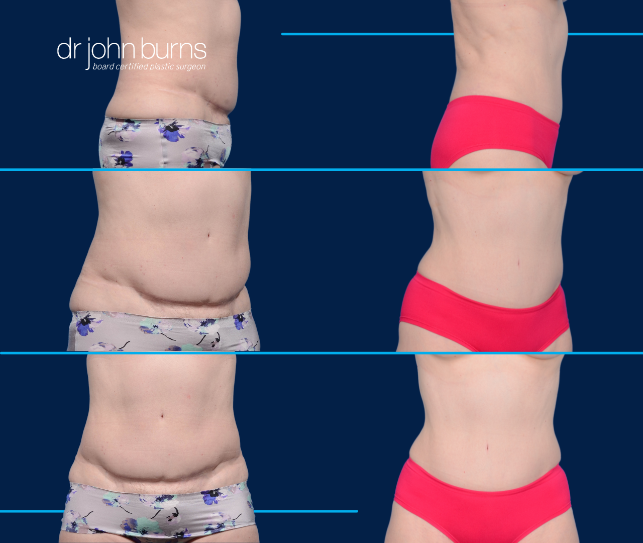 Case 11- Before & After Tummy Tuck Revision with Liposuction by Dr. John Burns