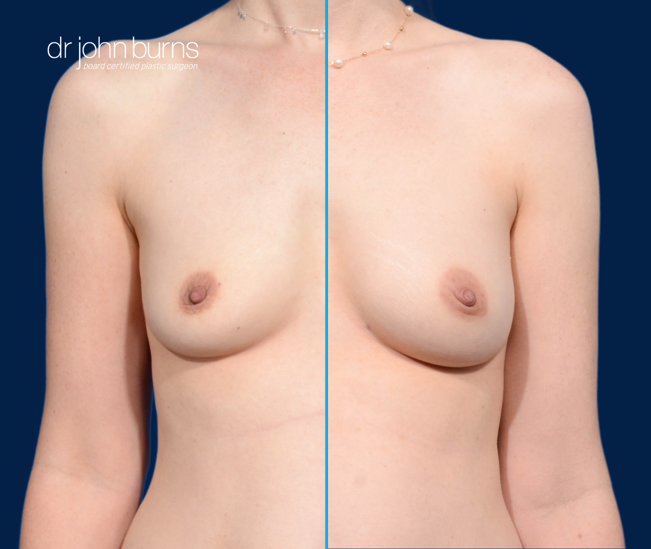 case 6- split screen before & after fat transfer to breast by top plastic surgeon, Dr. John Burns
