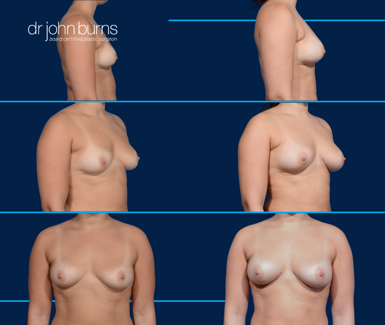 case 7- before and after breast augmentation fat transfer by top plastic surgeon, Dr. John Burns