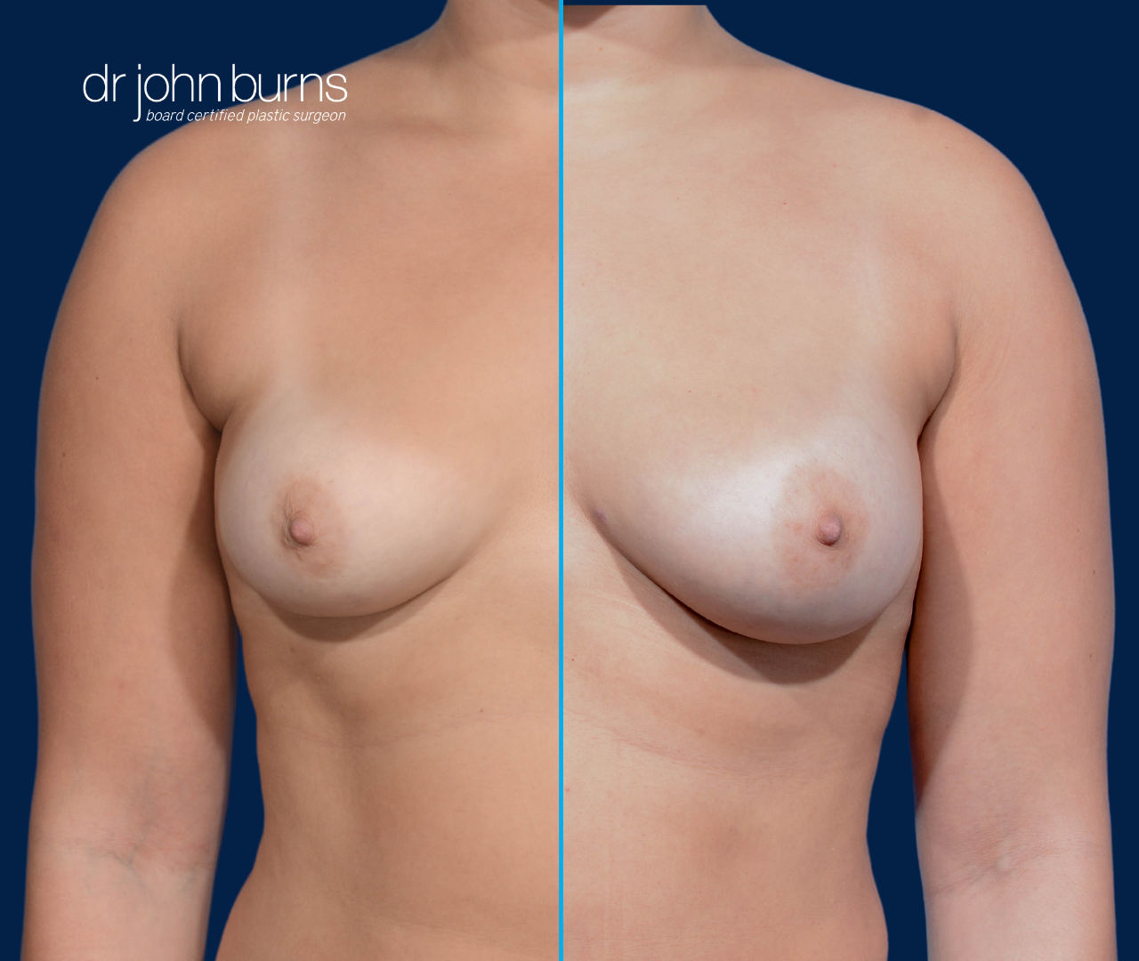 case 7- split screen before & after fat transfer to breast by top plastic surgeon, Dr. John Burns