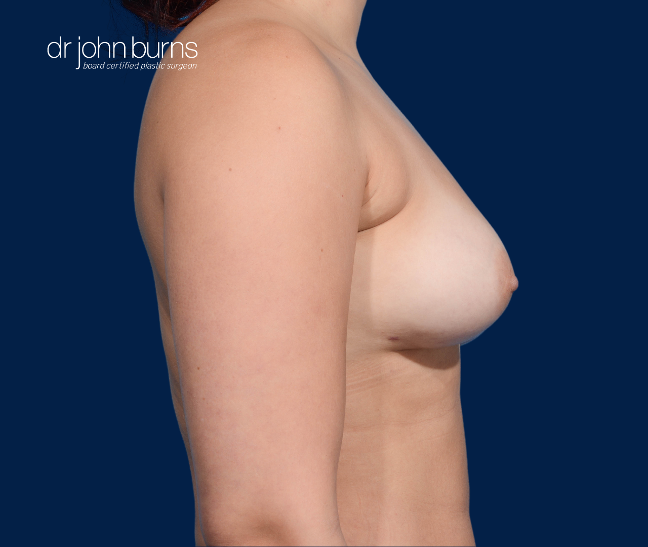 case 7- profile view | after fat transfer to breast by top plastic surgeon, Dr. John Burns