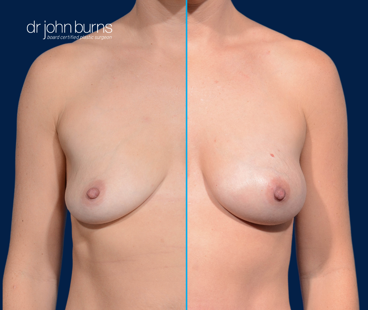case 8- split screen before & after fat transfer to breast by top plastic surgeon, Dr. John Burns