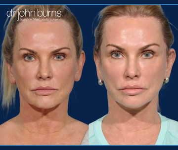 Before and After of Caucasian Woman who had a Lift and Fill facelift