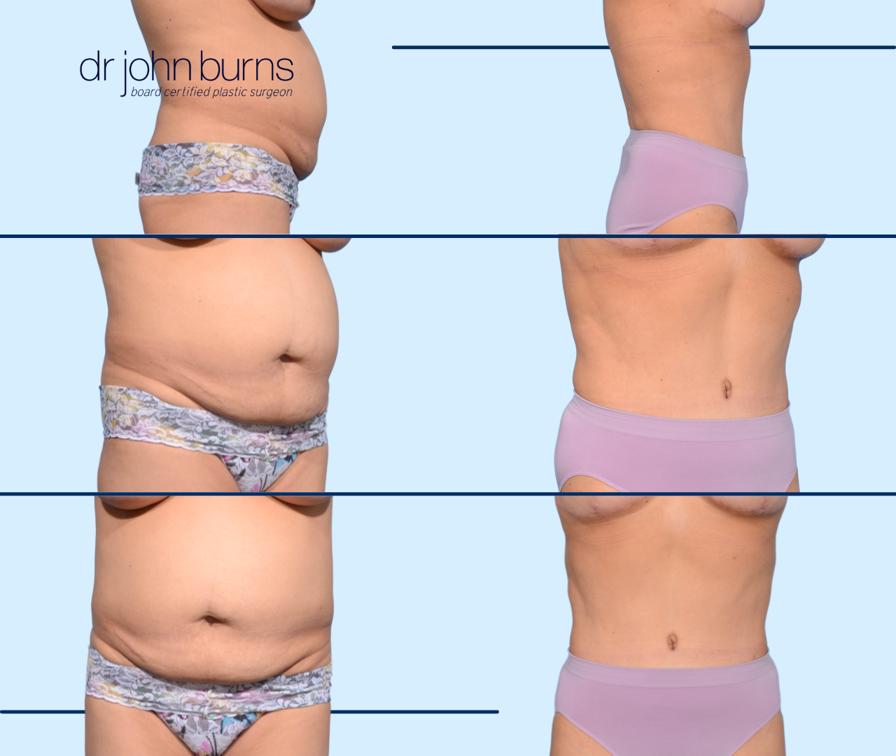 Case 8- Before and After Tummy Tuck with LIpo 360, Dallas, Texas