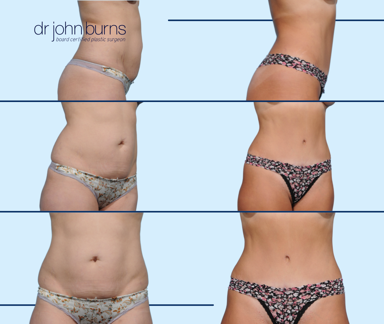 Case 9- Before & After Mommy Makeover Tummy Tuck with Liposuction