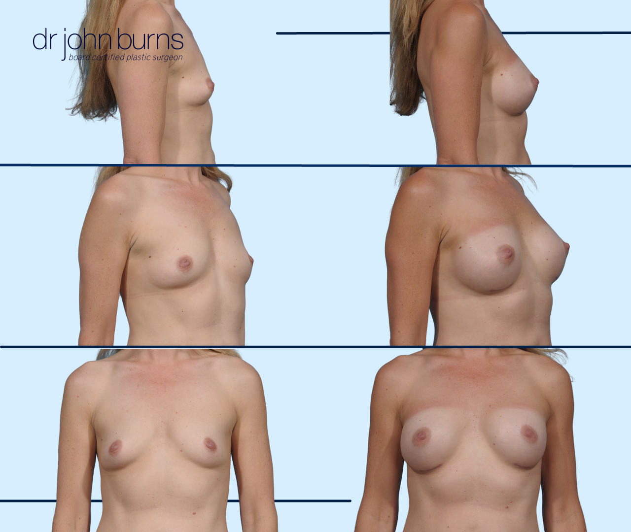 3 sets of before and after silicone gel breast implants on a caucasian woman