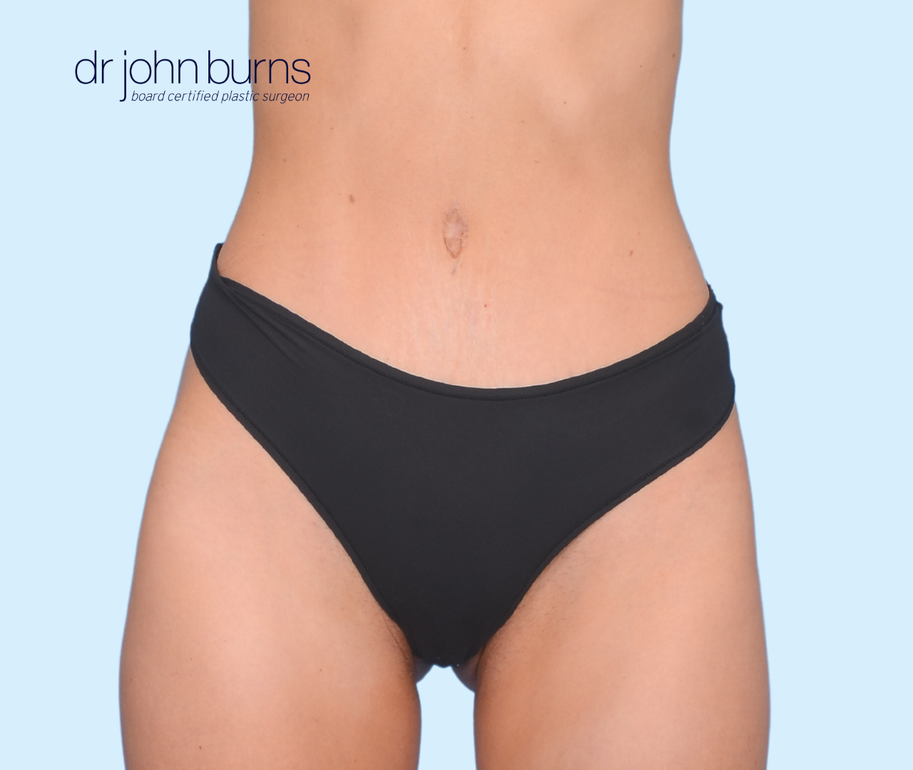 tiny tummy tuck result with scar covered by black bikini bottoms