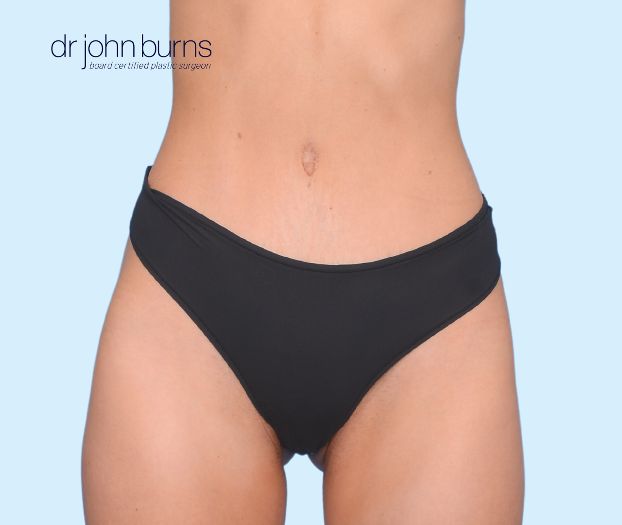 Mini Tummy Tuck Results- Dallas Mommy Makeover- Dr. John Burns – Dr John  Burns