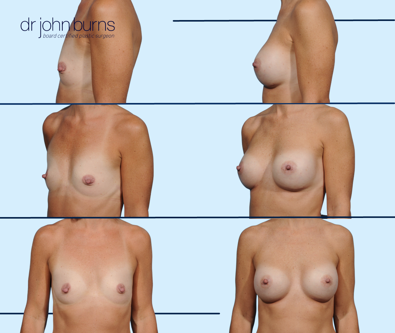 3 sets of before and after silicone gel breast implants on a caucasian woman