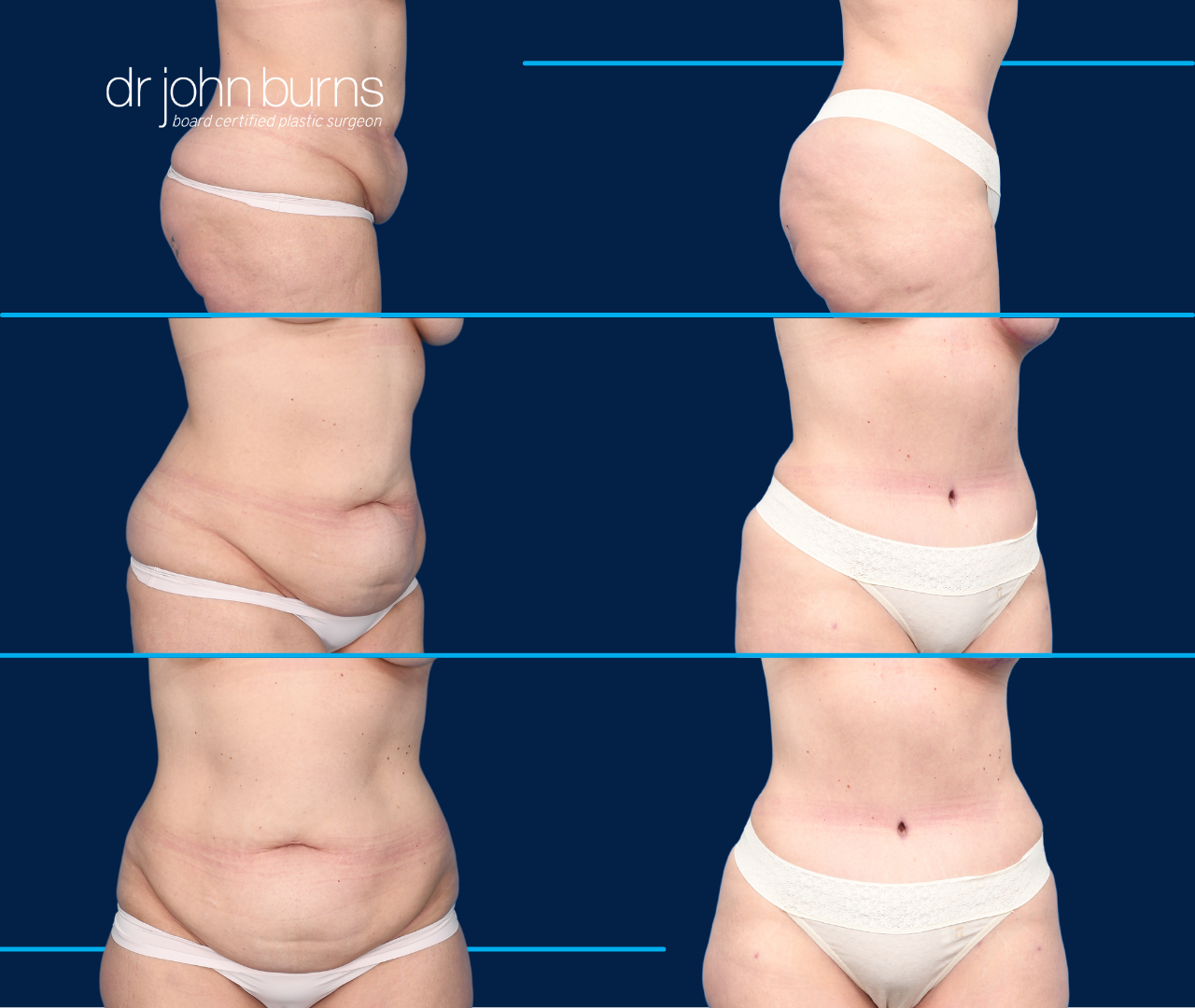 Before & After Hourglass Tummy Tuck by Dallas Plastic Surgeon, Dr. John Burns