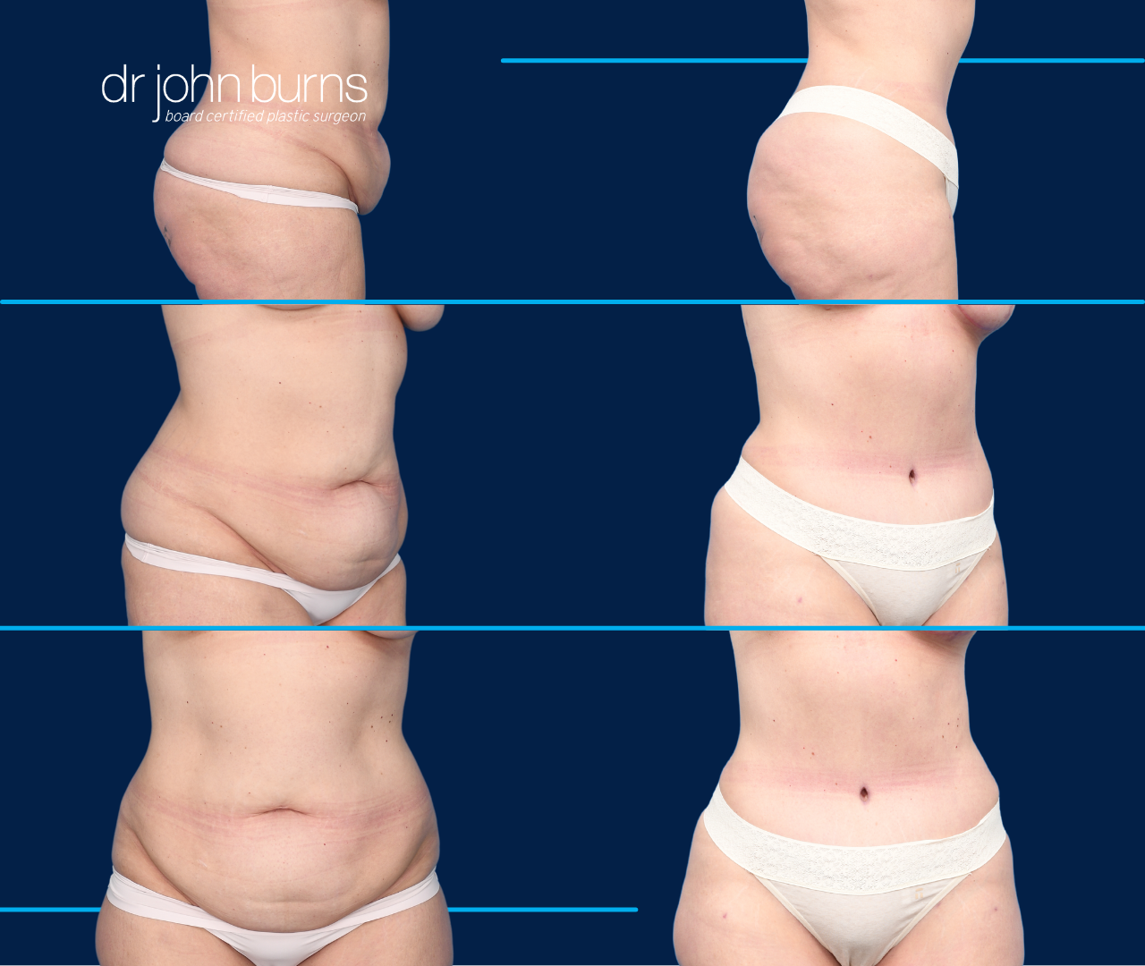 Hourglass Tummy Tuck: Helpful Guide About the Procedure