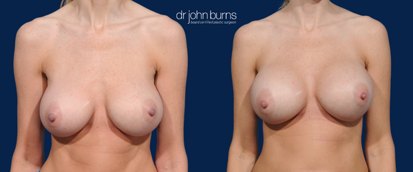 Before and After Bottomed-Out Breast Implant Repair by Dr. Burns