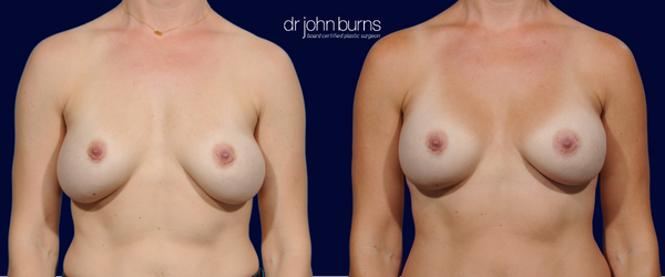 Before and After Lateral Displacement repair after breast augmentation