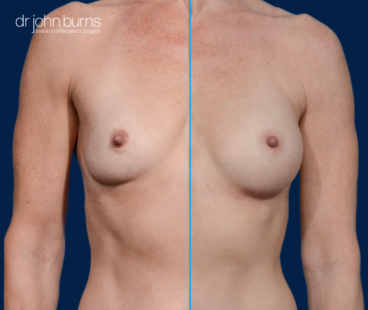 split screen before and after breast aug