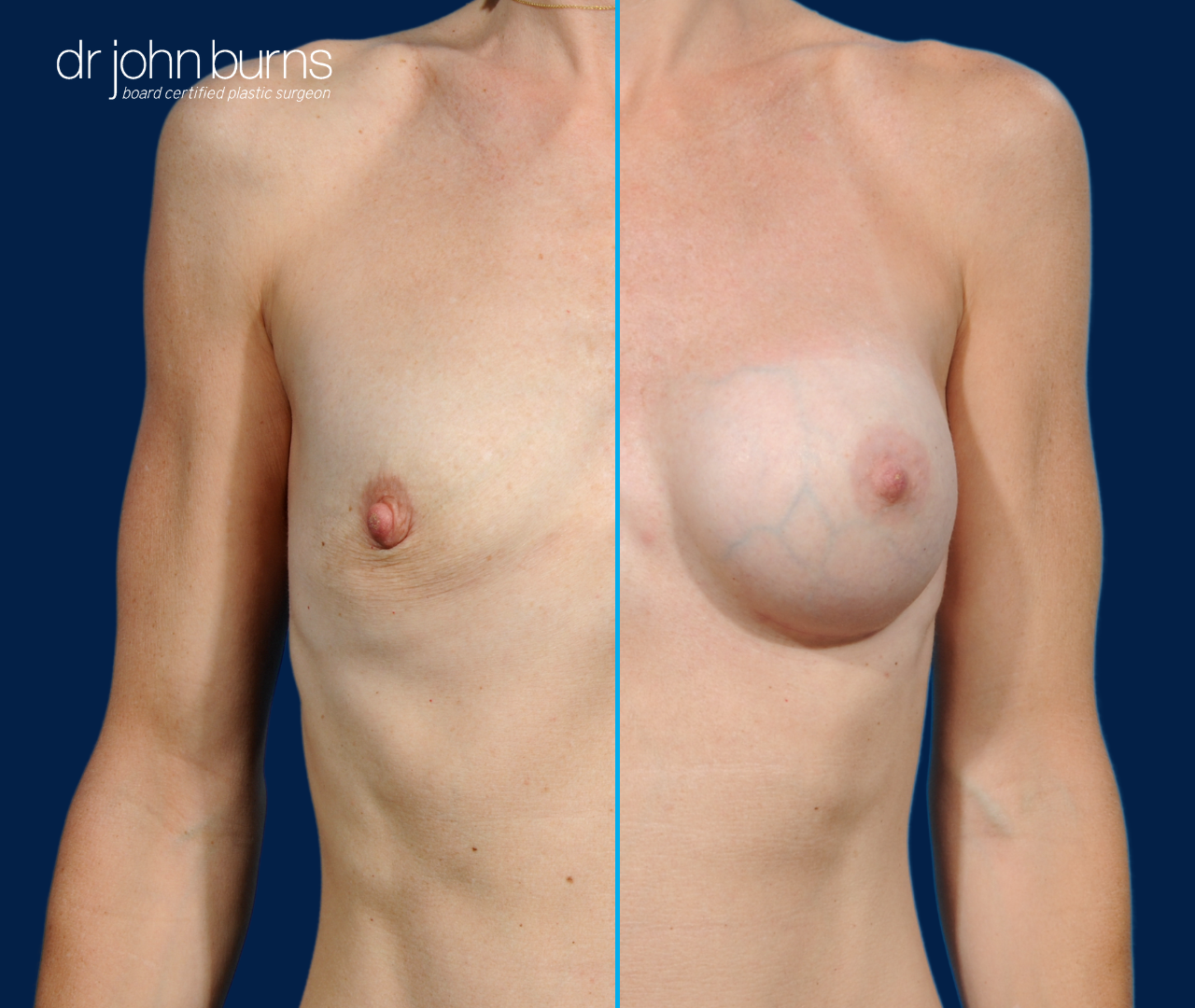 split screen before and after breast implants by Dr. John Burns