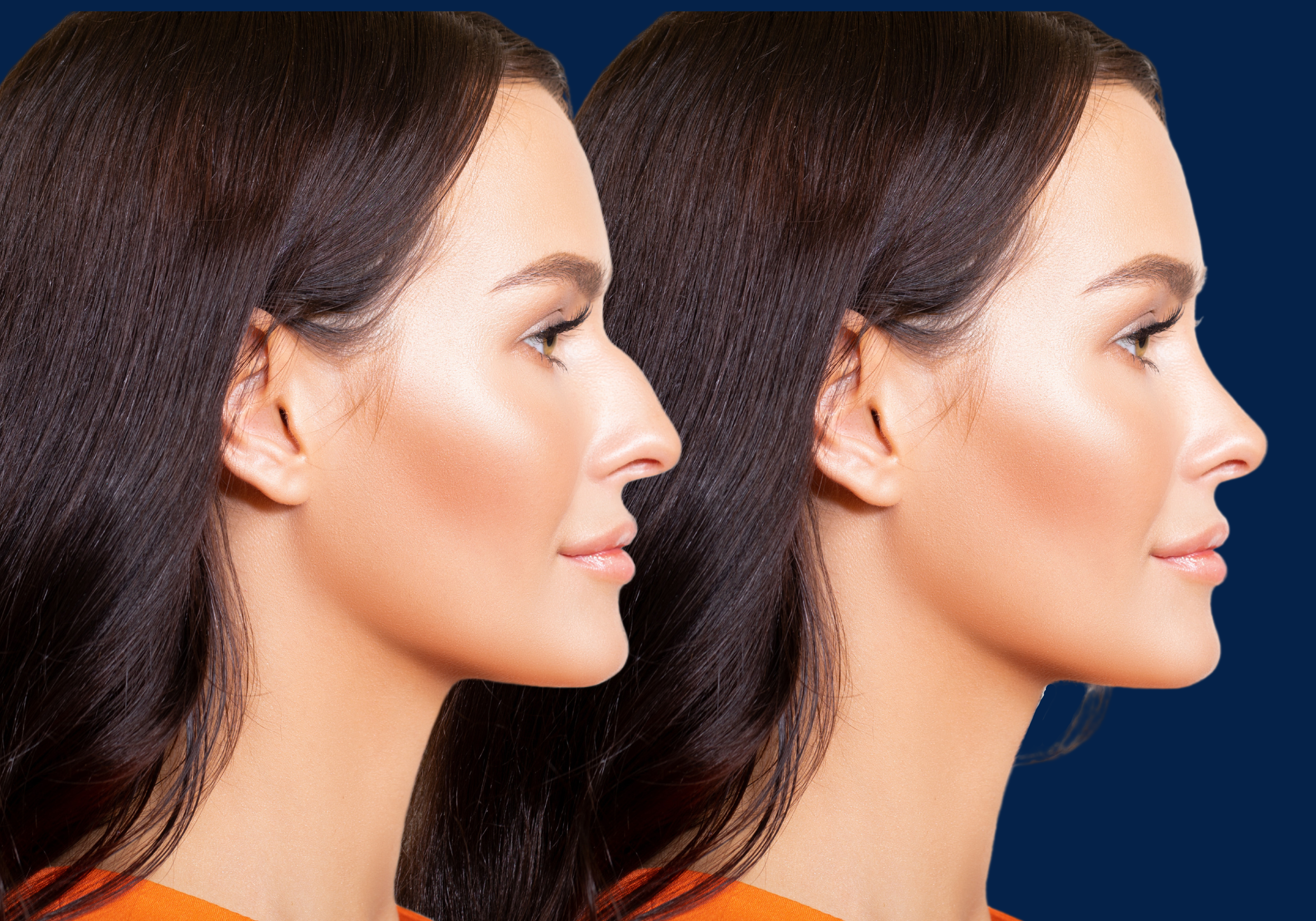 Before and After Rhinoplasty of a brunette woman