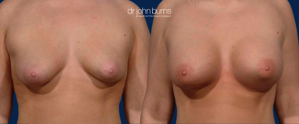 before and after image of a woman's chest with asymmetric breasts after breast augmentation