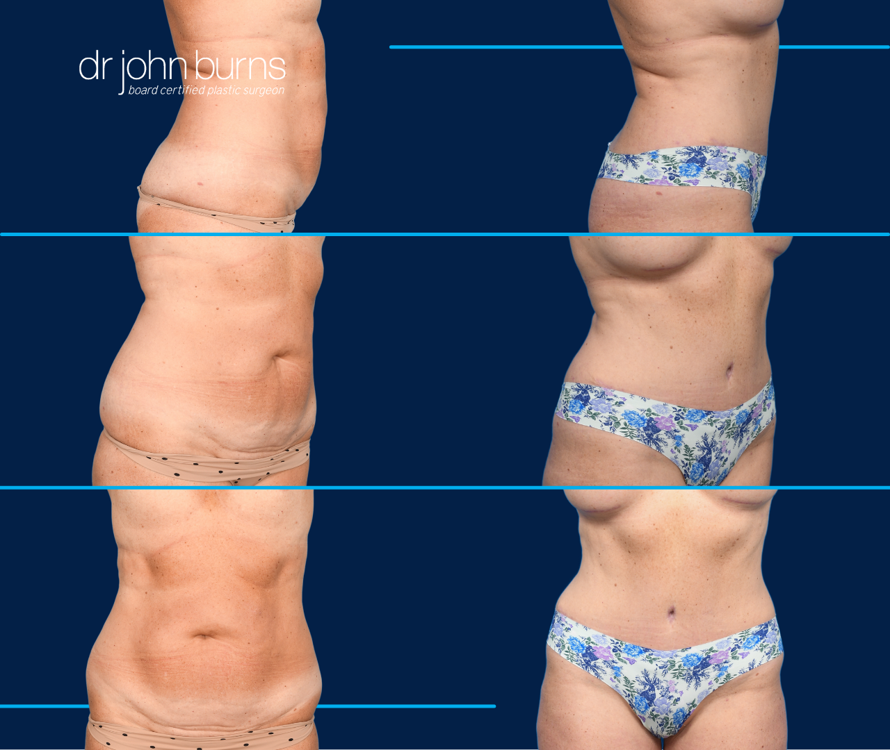 Liposuction with Buttock Augmentation Gives You an Hourglass Figure - Dr J  Plastic Surgery