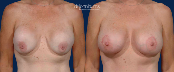 Before & After Capsular Contracture Repair Breast Augmentation