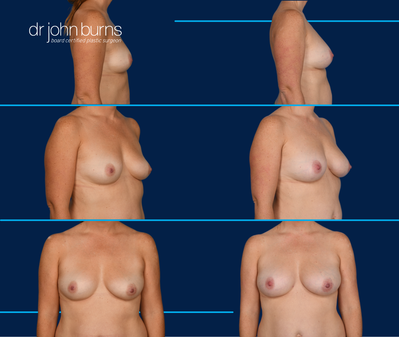 case 10- before and after breast augmentation fat transfer by top plastic surgeon, Dr. John Burns
